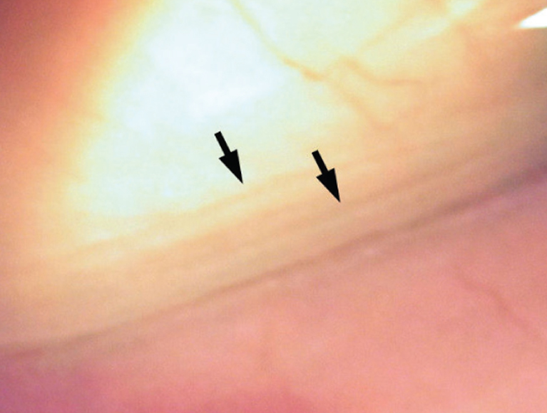 How to manage patients with Lid Parallel Conjunctival Folds (LIPCOF)
