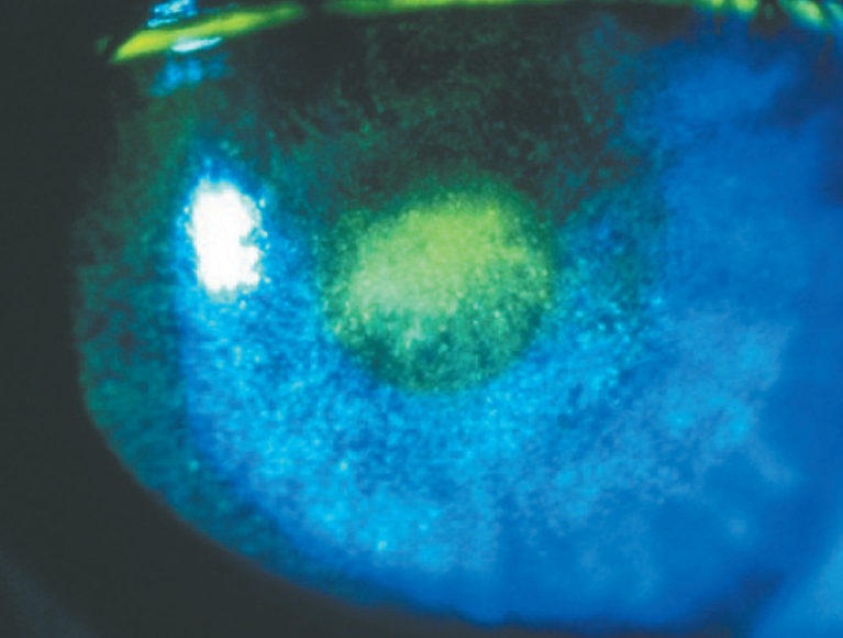 How to manage patients with Corneal Staining