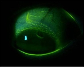 Superior epithelial acurate lesion (SEAL)